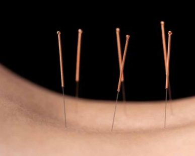Acupuncture treatment for backpain in london