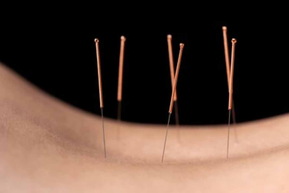 Acupuncture treatment for backpain in london