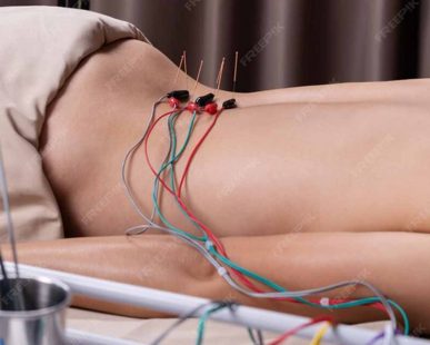 Acupuncture treatment in london