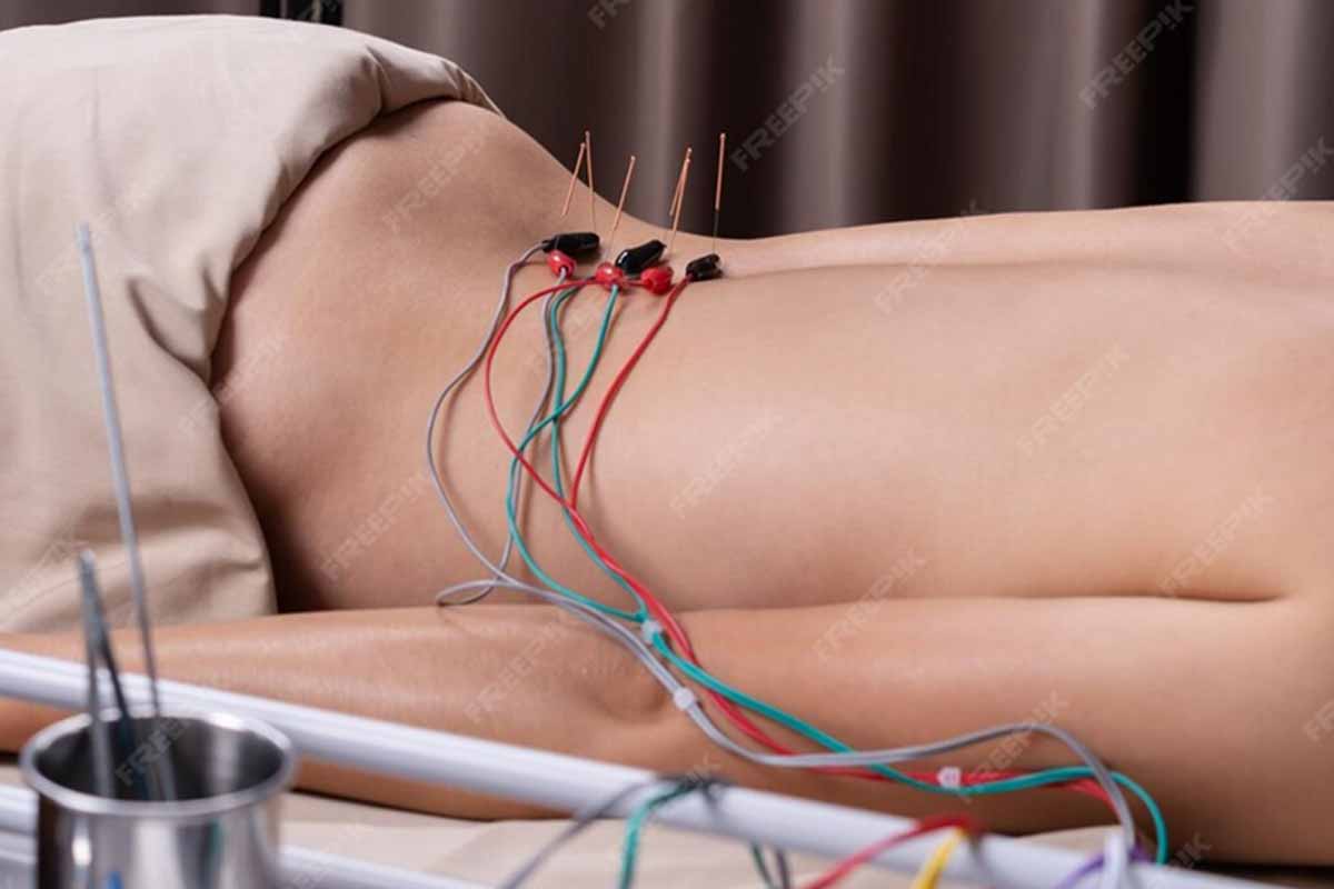 Acupuncture treatment in london