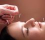 woman health acupuncture 90x80